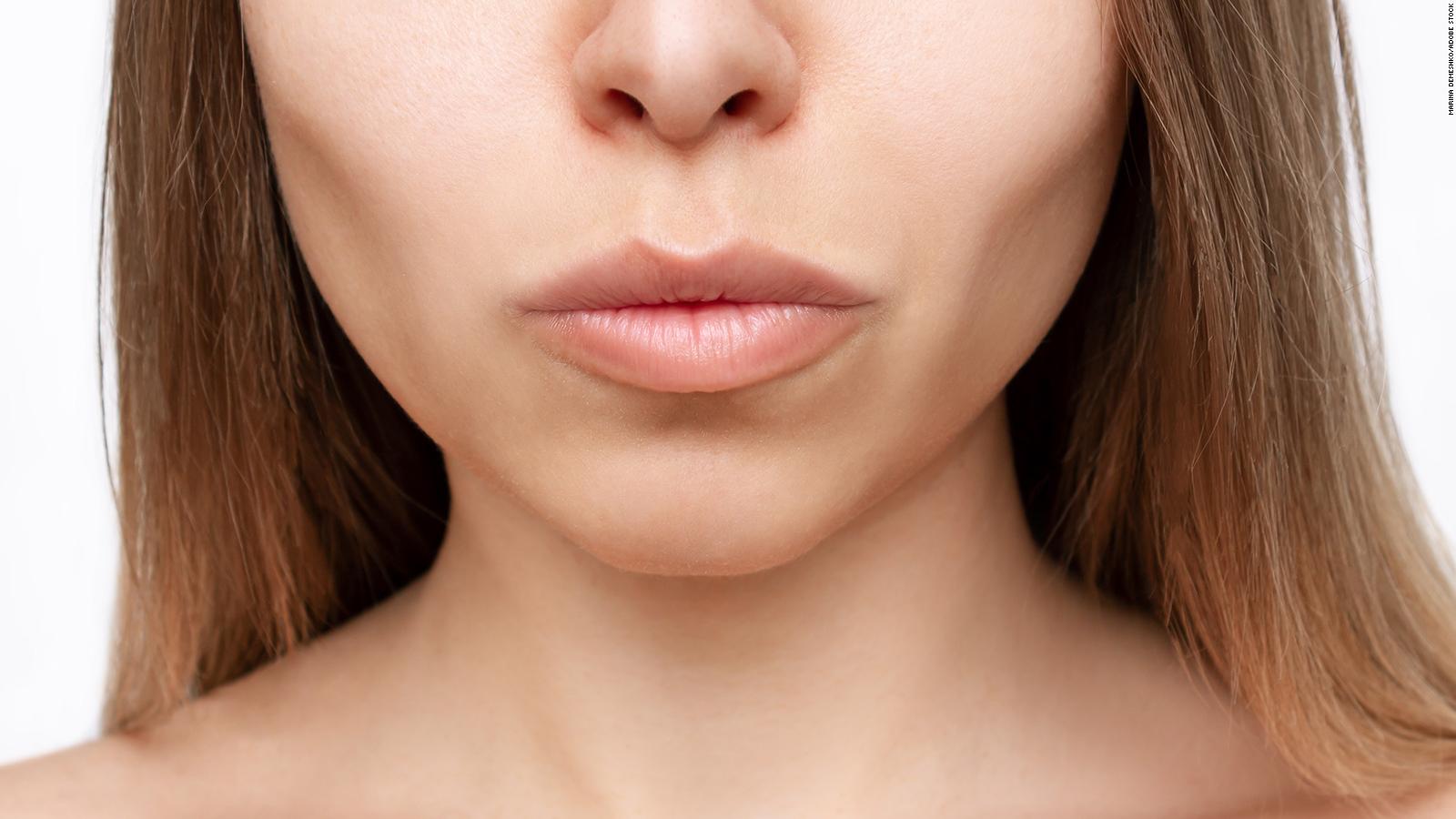 Pudgy cheeks are out: Buccal fat removal is taking Tik Tok over by storm